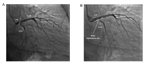 Complex coronary interventions, including chronic total occlusions (CTO ...