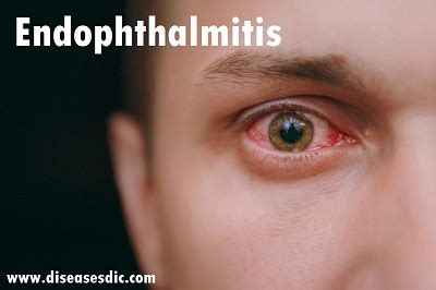 Endophthalmitis – Classification, Symptoms, and Prevention