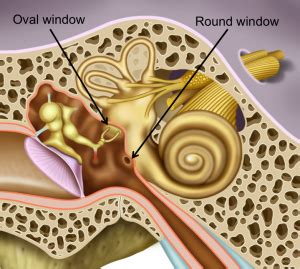 Perilymphatic fistula | Polyclinique Centre-Ville