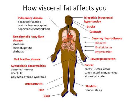 Visceral Fat: Causes, Types, Ranges of Visceral Fat, Health Risks