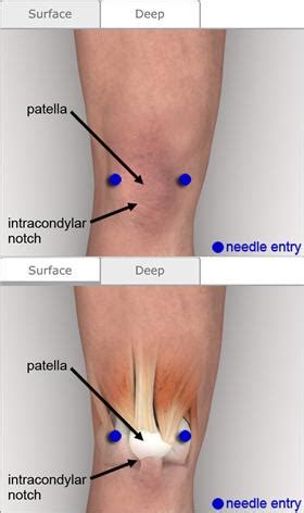 Arthrocentesis: Knee - Procedures CONSULT JAPAN