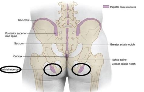 Ischial Bursitis