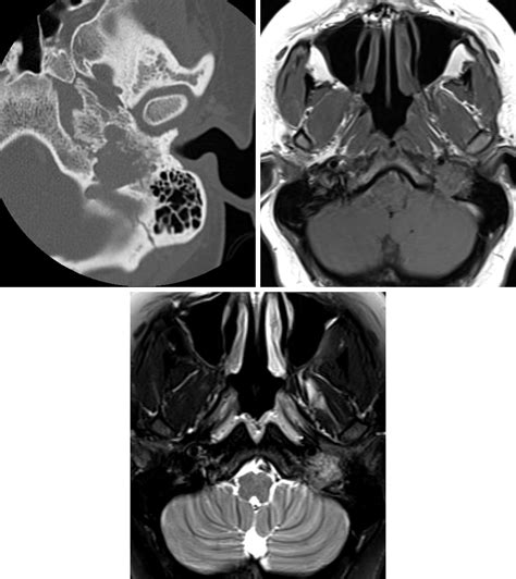 Glomus Jugulare Paraganglioma | The Neurosurgical Atlas