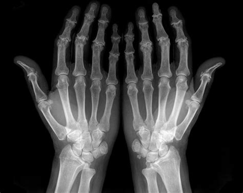 Osteoarthritis Hands X Ray