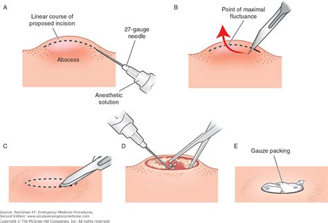 Incision And Drainage Of Abscess SpringerLink, 59% OFF