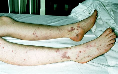 Patient Legs With Bacterial Septiceamia Photograph by John Radcliffe ...