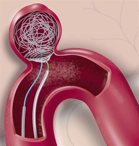 Endovascular treatment of wide-necked intracranial aneurysms using the ...