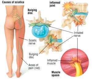 Can You Use TENS for Sciatica Pain Relief?