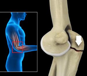 Elbow Fractures NSW | Elbow Joint Pain Treatment NSW