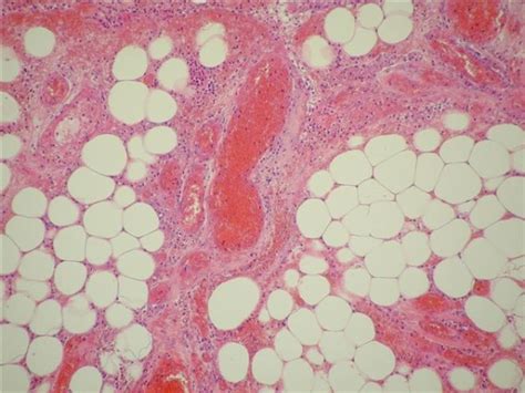 Histology displaying omental torsion characterised by congested... | Download Scientific Diagram