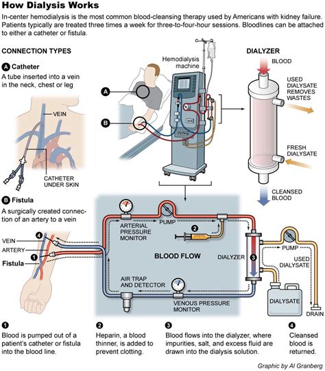 hemodialysis - a GREAT description of the process! | dialysis | Pinterest | Dialysis, Medical ...