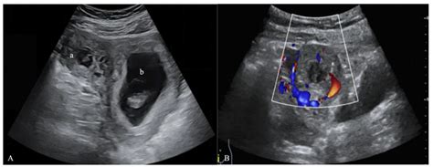 9 Week Ectopic Pregnancy Ultrasound