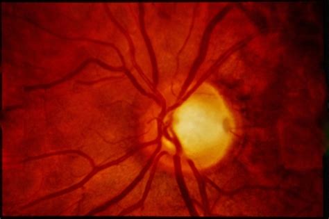 Optic Disc Pit - Retina Image Bank