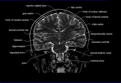 brain anatomy | MRI coronal brain anatomy | free MRI cross sectional anatomy | Brain anatomy ...