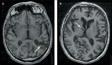 Figure 1 from Silent brain infarcts and leukoaraiosis in young adults with first-ever ischemic ...