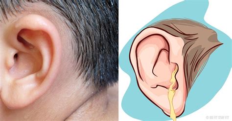 Natural Ways to Get Rid of Clogged Ears | Ear wax removal, Ear wax buildup, Clogged ears