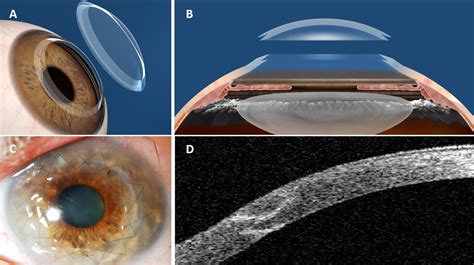 Surgical procedures in keratoplasty | Refractive Surgery Course