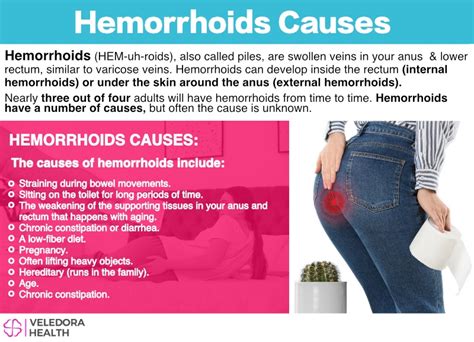 Hemorrhoids, Causes, Symptoms And Treatment!