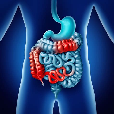 Inflammatory Bowel Disease (IBD) - Symptoms | familydoctor.org