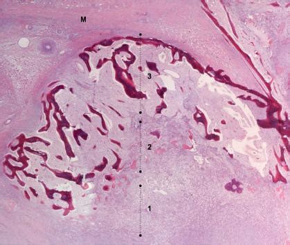 Russell's Blog: myositis ossificans histology