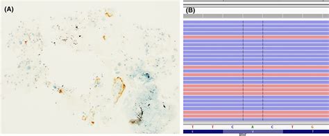 Assessment of BRAF V600E (VE1) immunochemistry for the detection of ...