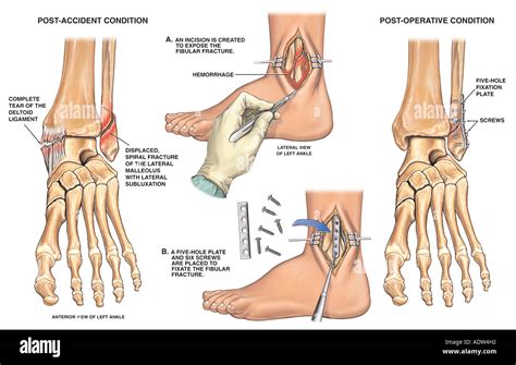 Lateral malleolus fracture hi-res stock photography and images - Alamy