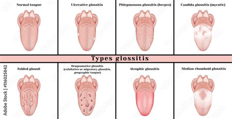 Types glossitis: candidiasis (mycotic), ulcerative, abscess (herpes ...