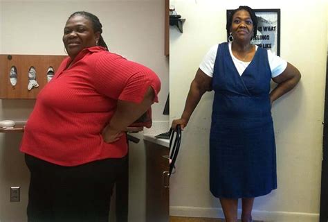 Before And After Gastric Bypass – 1 Year | Obesity Coverage