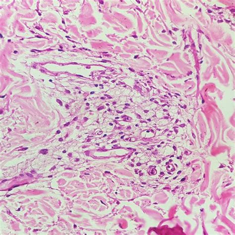 Multiple erythematous plaques with well-defined raised outer margins... | Download Scientific ...