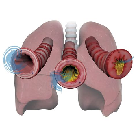 Lungs and bronchioles depicting asthma stages of inflammation and mucus Poster Print by Photon ...