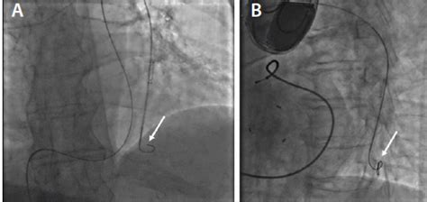 Cardiac Interventions Today - How to Implant the CardioMEMS Heart ...