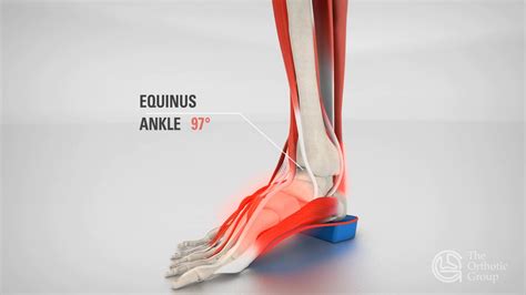 2 - Equinus Ankle - YouTube