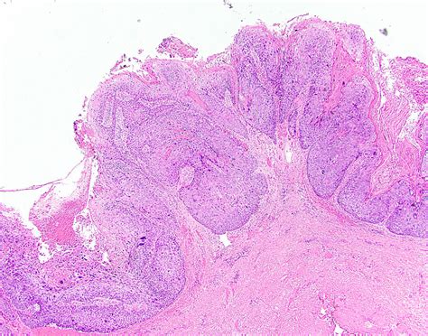 Pathology Outlines Squamous Cell Carcinoma Scc