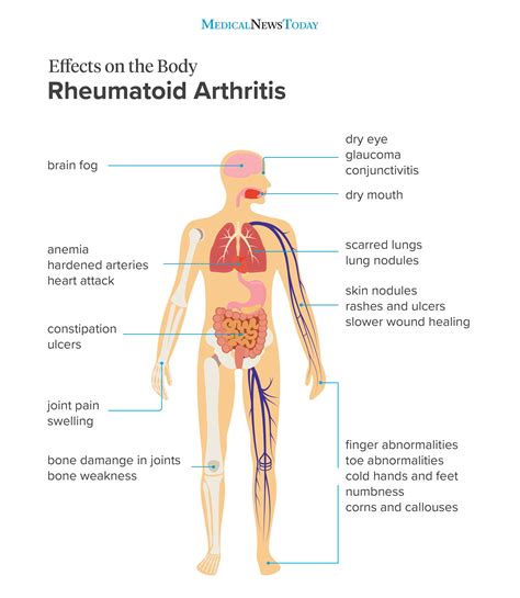 Effects of rheumatoid arthritis on the body