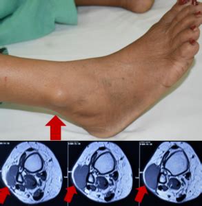 Soft Tissue Sarcoma Treatment in India | Cure Bone Cancer