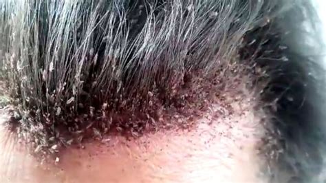 Head lice infestation - Symptoms, causes and risk factors