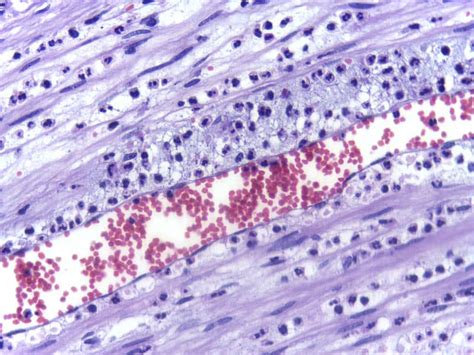 Acute Inflammation - Features - Exudate - TeachMePhysiology