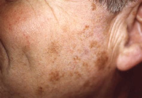 Liver Spots - Pictures (Face, Skin, Hands), Causes, Treatment