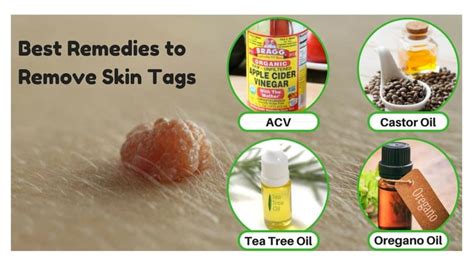 Best Ways that work well for Removing Skin Tags