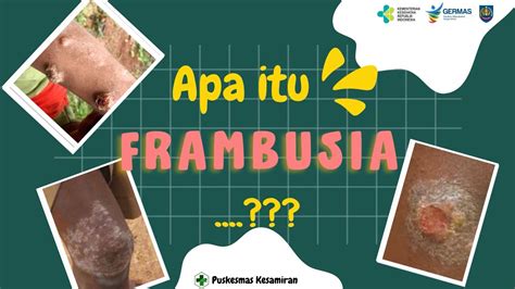 APA ITU FRAMBUSIA...?? | WUJUDKAN ERADIKASI FRAMBUSIA PUSKESMAS KESAMIRAN - YouTube