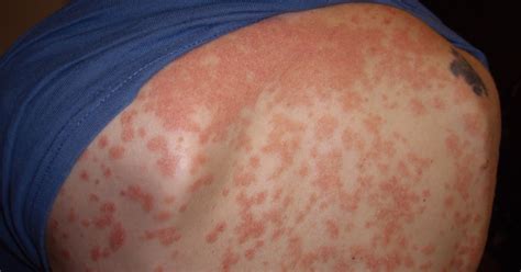 Psoriasis Pictures: Identifying Your Rash | Universal Body Health