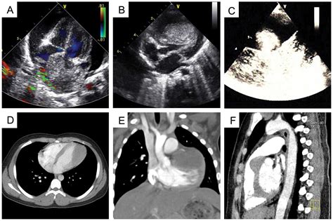 Surgical treatment of primary cardiac tumors in children: Experience of a single institute