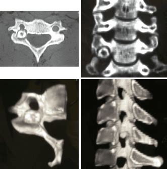 Osteoid osteoma like unusual cause of cervico-brachialgia