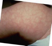 Mottled skin on baby? | BabyCenter