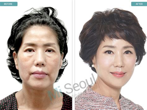 Korea Plastic Surgery Before and After photos