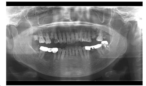 Panoramic dental radiograph. A radiolucent destructive lesion and ...