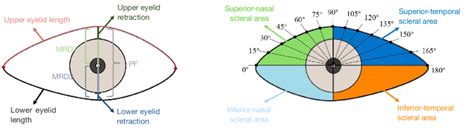 A schematic diagram of the eyelid morphological parameters. MRD1 and 2 ...