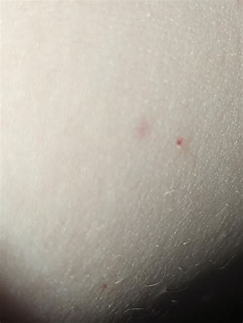 Leukemia Petechiae? : r/AskDocs