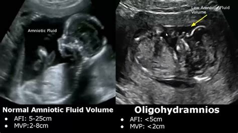 Fetal Presentations Ultrasound Images, 53% OFF