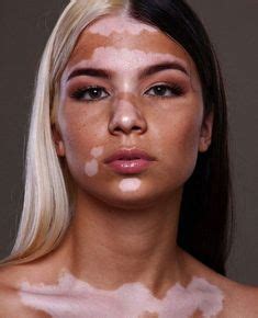 510 VITILIGO ideas | vitiligo, vitiligo treatment, vitiligo cure